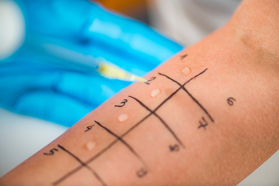 Prick test: cos’è, come si esegue e cosa rivelano i risultati